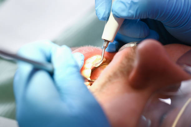 Best Emergency Root Canal Treatment in Rosemead, CA